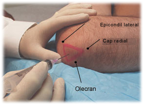 Artrita artrozei articulației umărului Bloc de artroză a articulației cotului