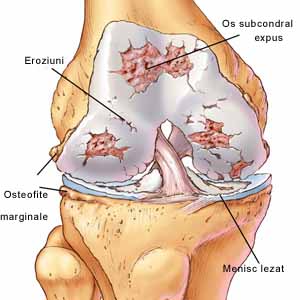 hidrocortizon pentru artroza genunchiului