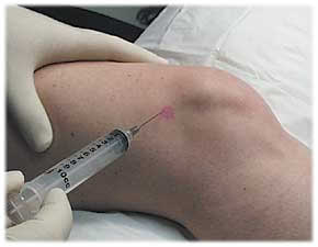 Tehnica injectării genunchiului - Tratamentul artrozei genunchiului prin injecție intraarticulară